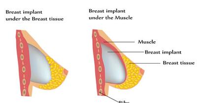 augmentation breast photo surgery Aunt judys xxx